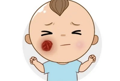 血管瘤患者秋季出游需要注意以下事项！