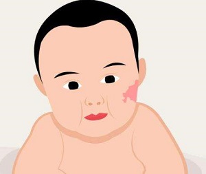 胎记患儿家长应当成为孩子健康的守护线！