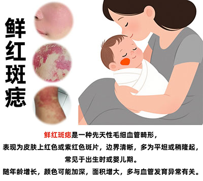 鲜红斑痣长在面部怎么治疗？南京胎记医院排名？
