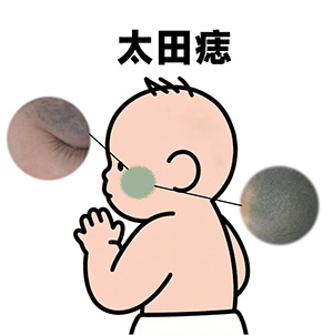 南京胎记医院排名：药物治疗太田痣有效吗？